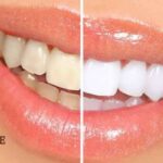 پک سفید کننده دندان دنتال وایت 20 دقیقه