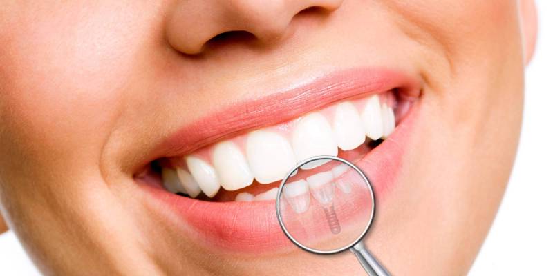 ایمپلنت فوری دندان چیست + مراحل + مزایا و معایب - خبرخوان تی شین