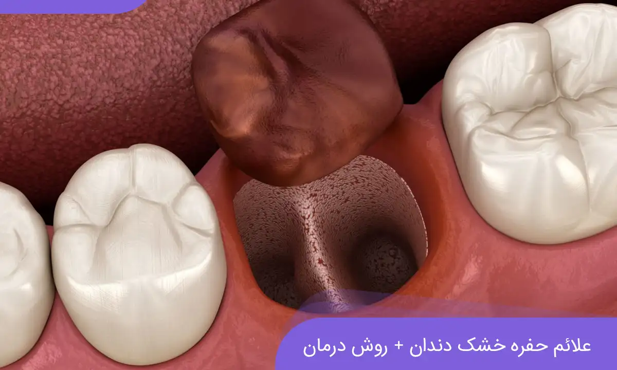 حفره خشک دندان (Dry Socket) چیست؟ + درمان حفره خشک دندان - خبرخوان تی شین