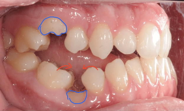 اهمیت دندان های عقب و محل قرار گیری آنها - خبرخوان تی شین