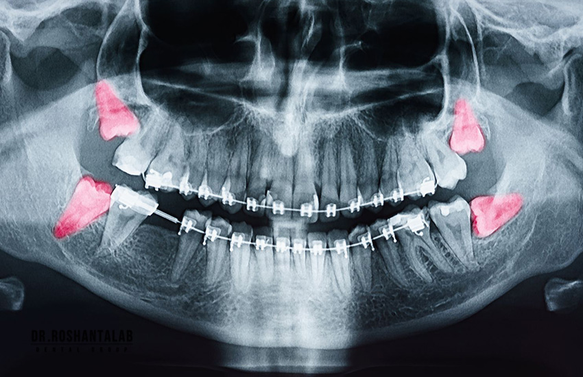 کشیدن دندان عقل - خبرخوان تی شین