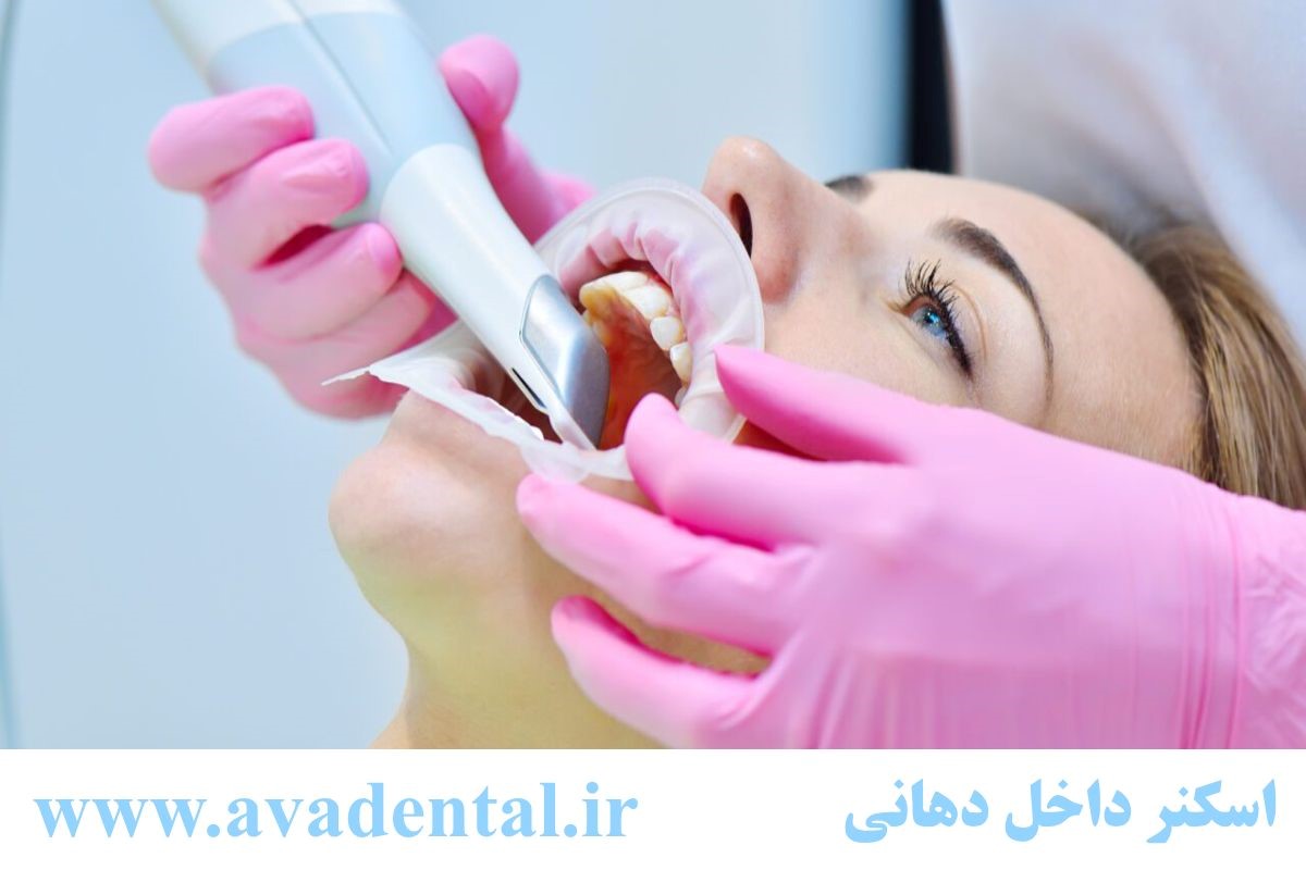 مزایای استفاده از اسکنرهای داخل دهانی در دندانپزشکی: دقت، سرعت و راحتی برای بیماران - خبرخوان تی شین
